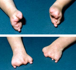 FIGURE 50-1, Disruptive loss of fingers in the hand (affecting central digits more severely). The mother of this fetus underwent CVS at 7 to 8 weeks, and, in addition to these digital reduction defects, there was a flank hemangioma.