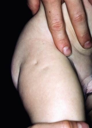 FIGURE 50-2, Amniocentesis puncture needle marks on an infant's thigh. The parent reported that the amniocentesis was done without ultrasound guidance and that the needle had to be repositioned several times before eventually drawing bloody amniotic fluid, which yielded a normal male karyotype.