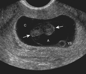 Figure 58-1, Normal 9-week intrauterine pregnancy on US. Transvaginal US image demonstrates well-defined embryo ( arrows ) and yolk sac ( YS ) with normal separation of amnionic ( A ) and chorionic ( C ) sacs.