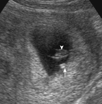 Figure 58-2, Early failed intrauterine pregnancy on US. Transabdominal pelvic US image shows calcified yolk sac ( arrow ) and embryonic remnant ( arrowhead ).