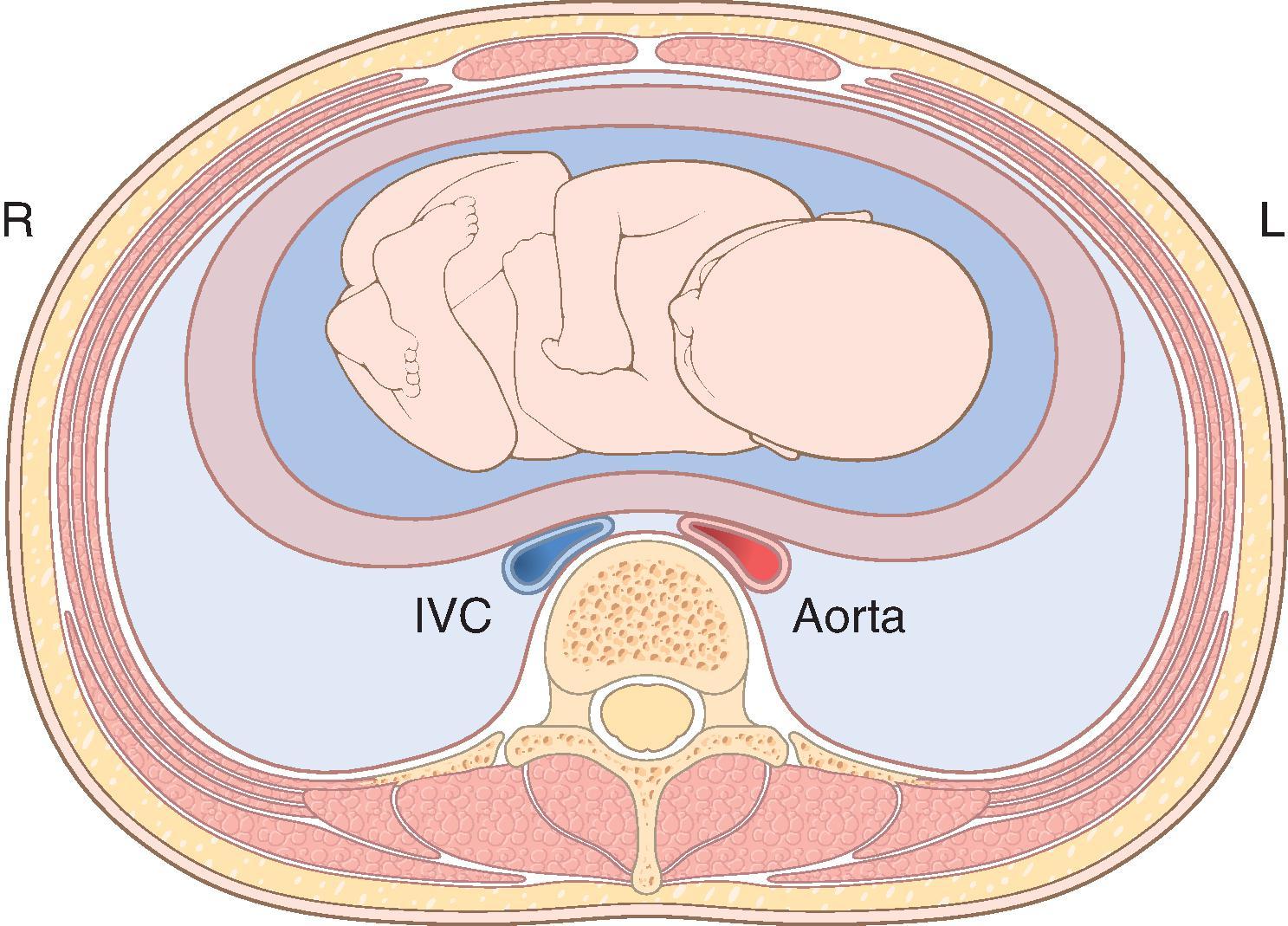 Fig. 33.1, Schematic diagram showing compression of the inferior vena cava (IVC) and abdominal aorta by the gravid uterus in the supine position.