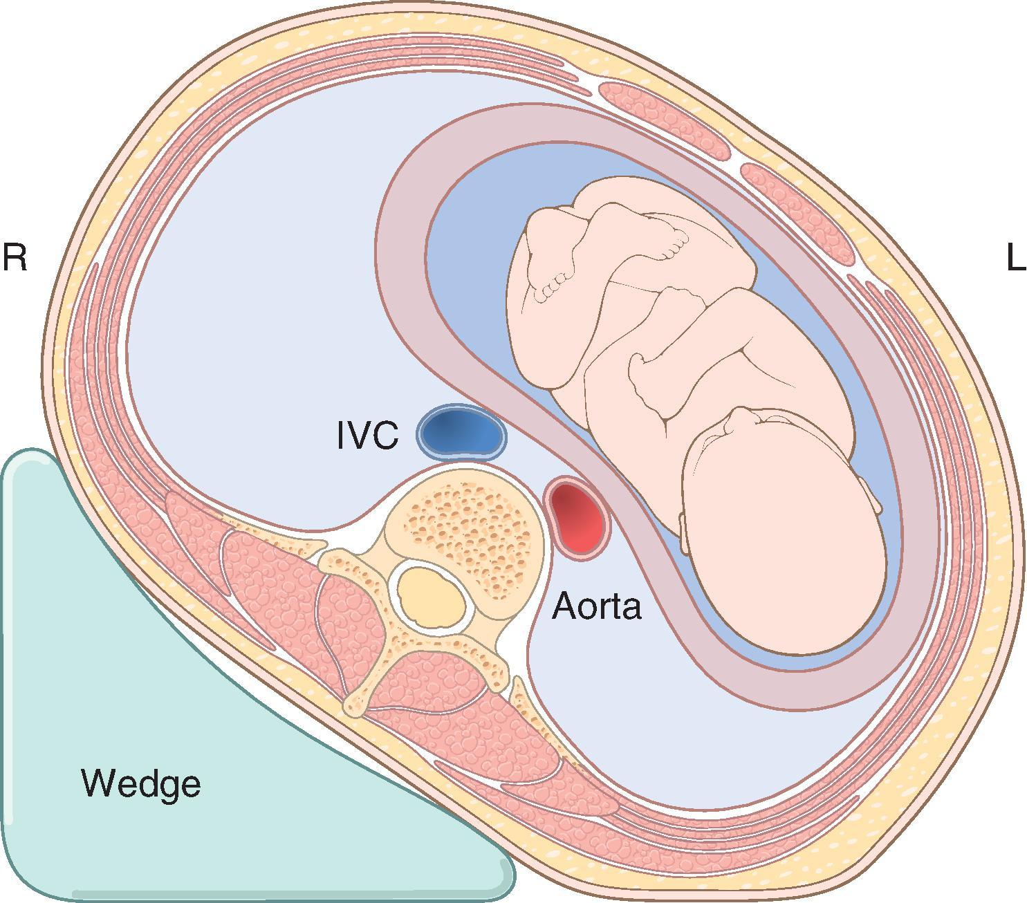 Fig. 33.2, Schematic diagram depicting left uterine displacement by elevation of the right hip with a wedge. This position deflects the gravid uterus off of the inferior vena cava (IVC) and aorta.