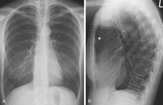 FIGURE 20.1, Hyperinflation of lungs in a smoker with chronic bronchitis. A, Posteroanterior radiograph demonstrates hyperlucent lungs and low diaphragm with more than 10 posterior ribs seen above the diaphragm at the midclavicular line. The cardiac silhouette appears long and narrow. B, Lateral radiograph shows increased anterior–posterior diameter of the thorax, widening of retrosternal clear space (asterisk) , and flattening of the diaphragm.