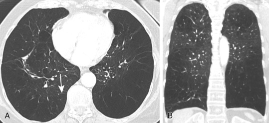 FIGURE 20.11, Panlobular emphysema in a patient with α 1 -antitrypsin deficiency and a history of cigarette smoking. A, Axial computed tomography image shows a pronounced paucity of vessels in both lower lobes, sometimes referred to as a simplification of lung architecture. “Empty” secondary pulmonary lobules nearly devoid of vessels can be identified (arrow) . B, Coronal reformation image shows the lower lobe predominance of panlobular emphysema and less severe centrilobular emphysema in the upper lobes.