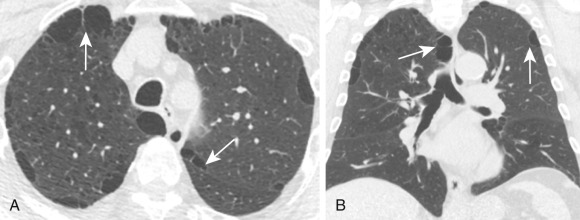 FIGURE 20.12, Paraseptal emphysema. Axial (A) and coronal (B) computed tomography images show lucent areas localized to the subpleural region (arrows) . The patient also has mild centrilobular emphysema.