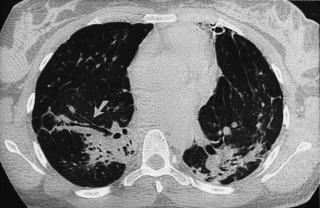 FIGURE 20.13, Paracicatricial emphysema in a patient with sarcoidosis and pulmonary fibrosis. Axial computed tomography image demonstrates bilateral parahilar fibrosis, architectural distortion, and traction bronchiectasis. Notice the dilated medial and lateral segmental bronchi in the right middle lobe (arrow) , which represent traction bronchiectasis, and areas of hyperlucency in the adjacent lung consistent with paracicatricial emphysema.