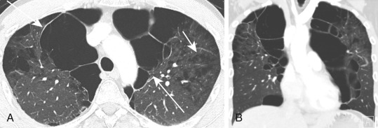 FIGURE 20.14, Vanishing lung syndrome in a 38-year-old man. A, Axial computed tomography (CT) image through the upper lobes shows bilateral bullae (long arrow) and centrilobular emphysema (short arrow). B, Coronal reformation CT image demonstrates more severe destruction of the upper lobe parenchyma than the lower lobes.