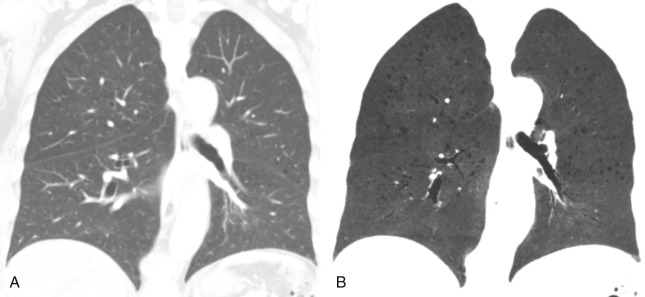 FIGURE 20.15, Mild emphysema better seen on minimum-intensity projection image (minIP). A, Coronal reformation computed tomography image demonstrates small lucent areas consistent with centrilobular emphysema. B, Coronal minIP shows the emphysema to better advantage.