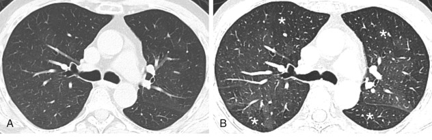 FIGURE 20.2, Air trapping on computed tomography (CT) image in a patient with post–stem cell transplant graft-versus-host disease and constrictive bronchiolitis. A The inspiratory CT image is nearly normal with very subtle mosaic attenuation of pulmonary parenchyma. B, Expiratory CT image shows anterior bowing of posterior wall of mainstem bronchi as expected during expiration. The normal areas of lung show increased attenuation because of decreased amount of air in the alveoli. Areas of lungs affected by air trapping remain lucent (asterisks).