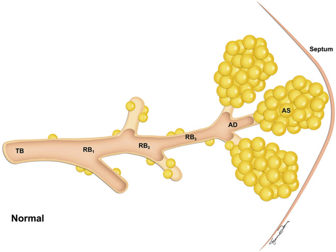 FIGURE 20.3, Normal lung. The acinus is the part of the lung distal to the terminal bronchiole (TB). AD, Alveolar duct; AS, alveolar sac; RB, respiratory bronchiole.