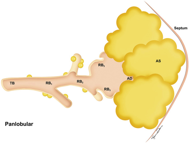 FIGURE 20.5, Panlobular emphysema. The enlargement and destruction of airspaces (A) involve the acinus more or less uniformly. AD, Alveolar duct; AS, alveolar sac; RB, respiratory bronchiole; TB, terminal bronchiole.