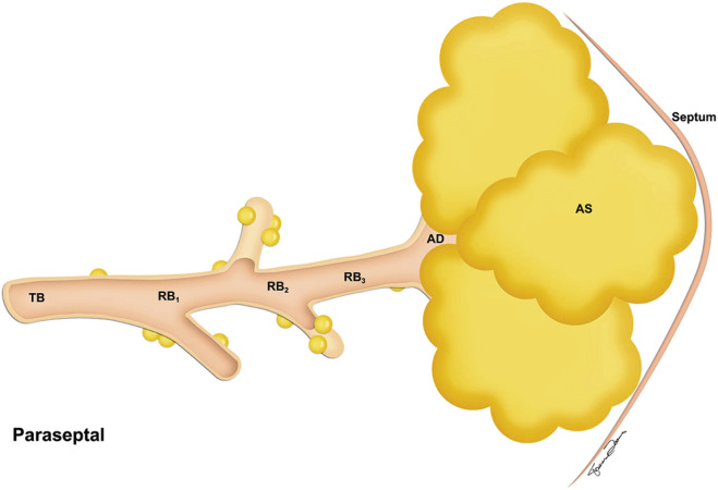 FIGURE 20.6, Paraseptal emphysema. The peripheral part of the acinus (alveolar ducts and sacs) is dominantly and selectively involved.