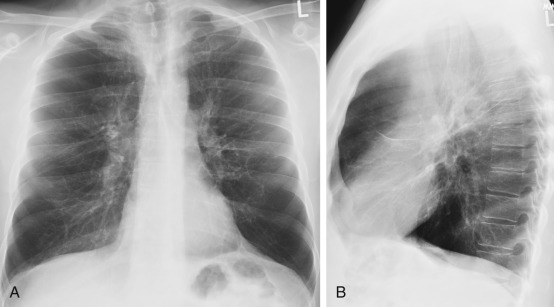 FIGURE 20.7, Emphysema in a patient with α 1 -antitrypsin deficiency. Posteroanterior (A) and lateral (B) chest radiographs show attenuation of pulmonary vessels at the lung bases compared with the upper lungs characteristic of panlobular emphysema. Notice the flattening of the diaphragm and increased retrosternal air.