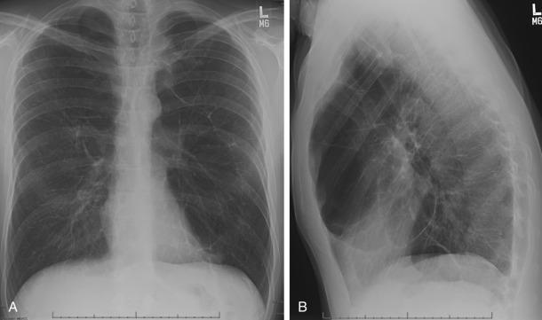 FIGURE 20.8, Bullae in a patient with vanishing lung syndrome. Posteroanterior (A) and lateral (B) chest radiographs show bilateral upper lobe bullae characterized by large lucent space with thin walls.