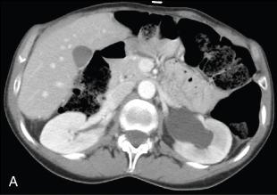 Fig. 31.1, A. Computed tomography (CT) abdomen with contrast showing incidental finding of left-sided hydronephrosis. B. CT abdomen with contrast, coronal view showing left-sided hydronephrosis. C. Ultrasonogram of the same patient demonstrating left-sided hydronephrosis-caliectasis, with interconnected fluid filled areas in the renal pelvis with a branching calyceal pattern.