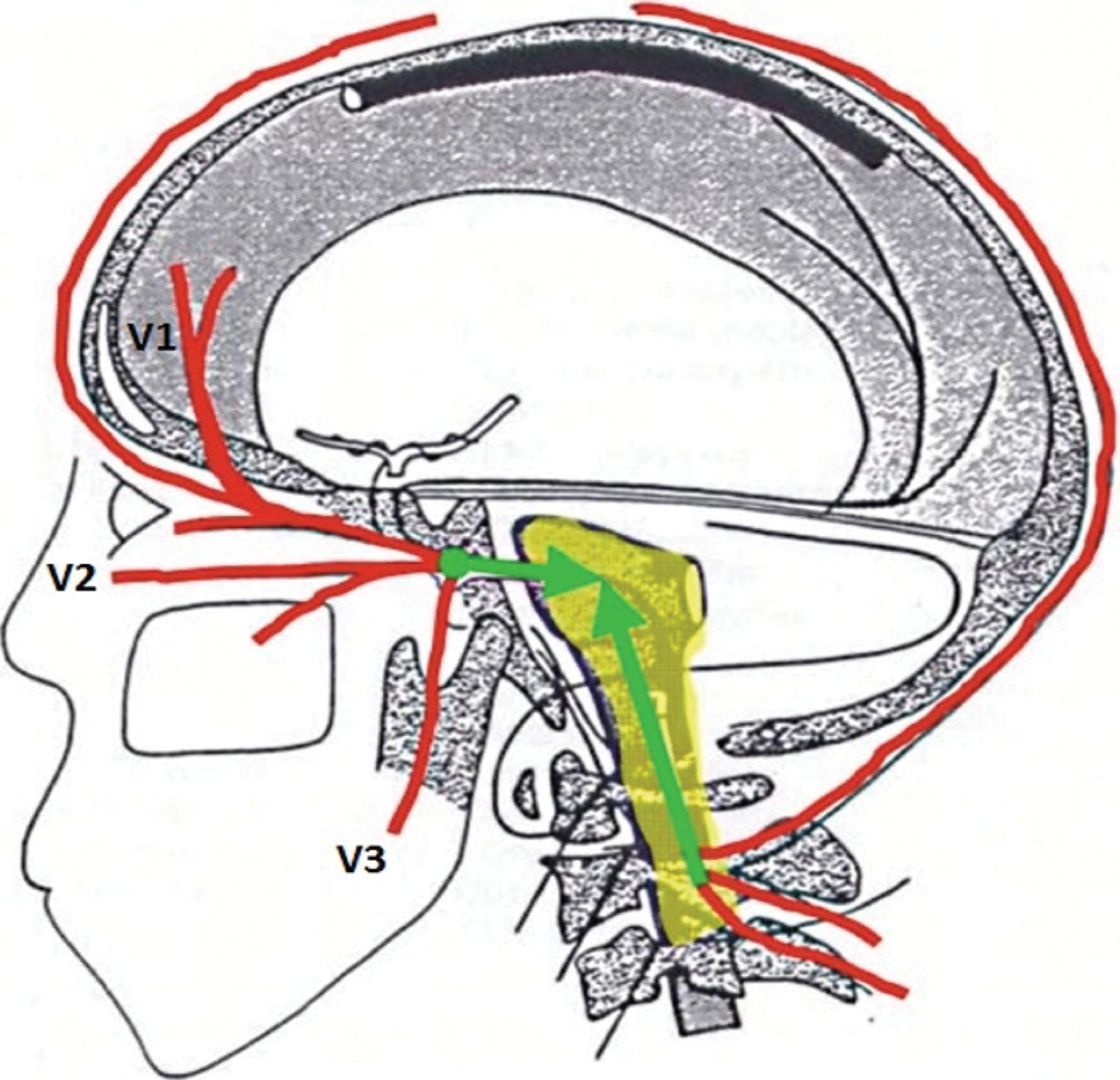 Figure 8.1, Cervico-trigeminal relay, showing the relationship between the occipital/upper cervical nerve roots and the trigeminal cranial nerves. V1, Ophthalmic division. V2, Maxillary division. V3, Mandibular division.