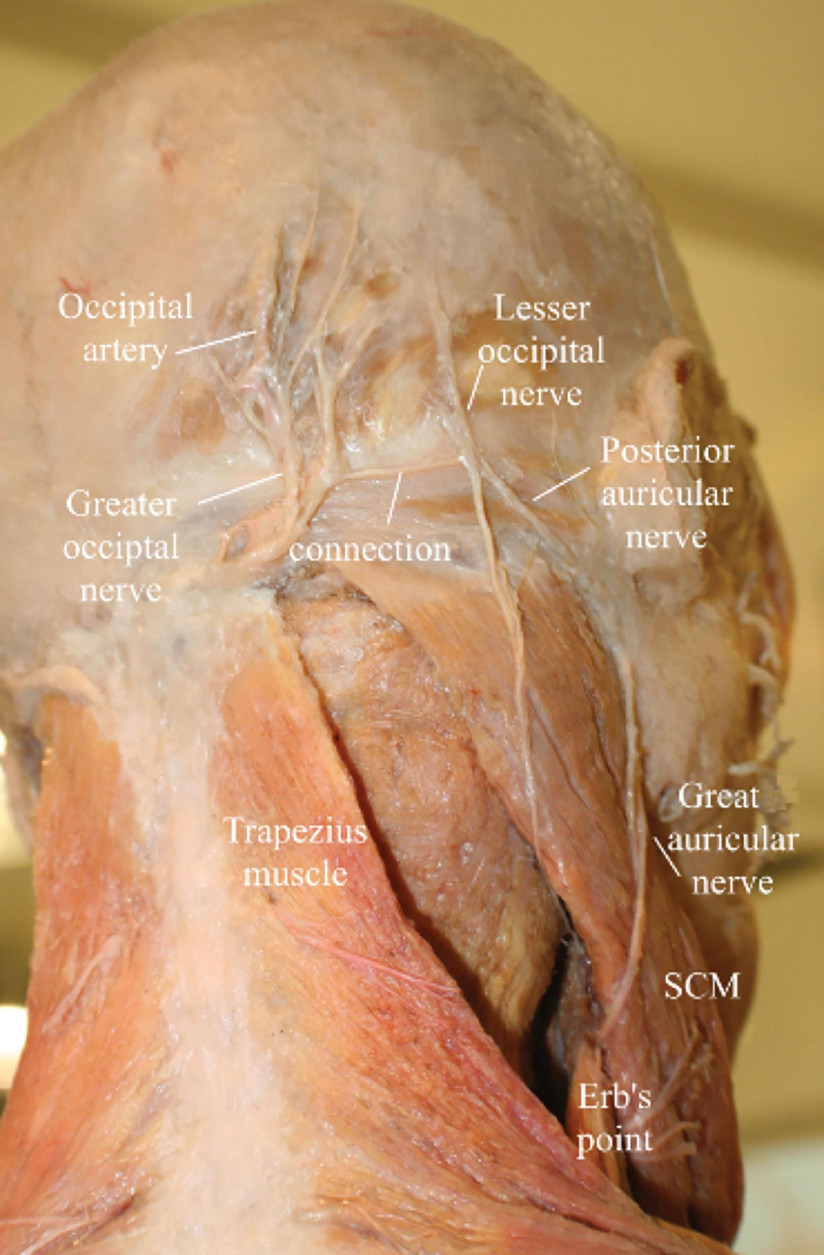 Figure 8.4, Anatomy of the occipital region. Note the connection of the greater and lesser occipital nerves. SCM , Sternocleidomastoid.