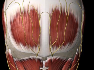 Figure 62.4, Occipital nerve complex superficial to the fascia at the inion and cephalad.