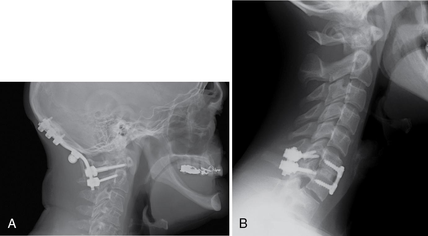Fig. 28.1, (A) Posterior occiput to C2 spinal instrumentation and fusion. (B) Anterior cervical plate, allograft bone graft, and posterior screw-rod instrumentation.