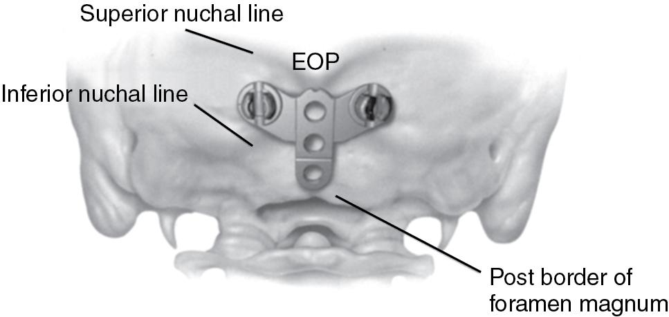 Fig. 28.2, Safe placement of occipital screws is in the region adjacent to the external occipital protuberance (EOP) and below the superior nuchal line.