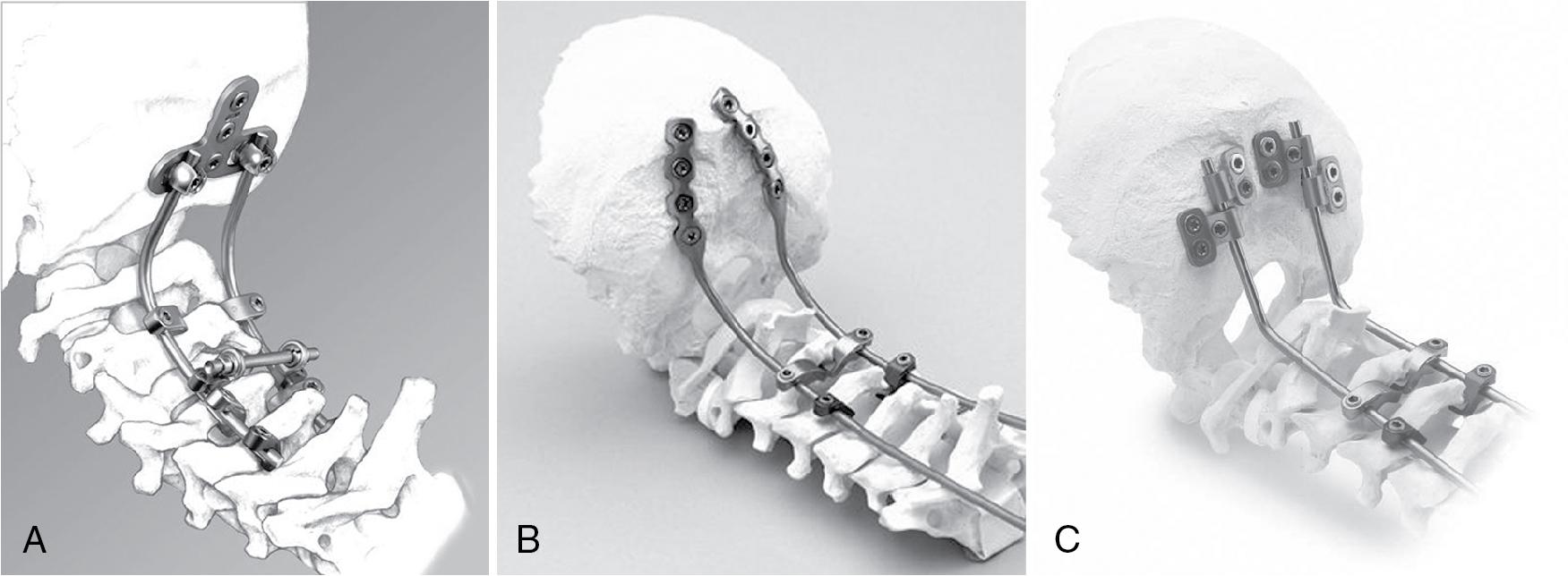 Fig. 28.3, Occipital screw linkage options. (A) Midline screw-plate. (B) Hybrid rod-plate. (C) Rod with specialized connectors.