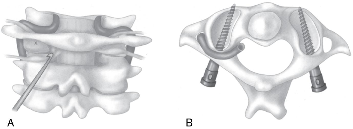 Fig. 28.4, (A) Posterior landmark for C1 screw placement. (B) C1 screw trajectory in the axial plane.