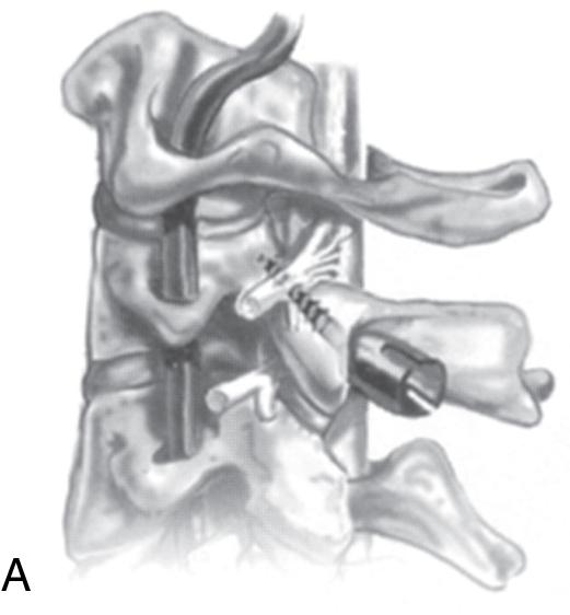 Fig. 28.5, C2 pars screw placement. (A) Lateral view. (B) Anteroposterior view.