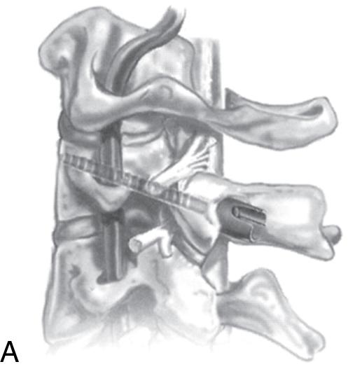 Fig. 28.6, C2 pedicle screw placement. (A) Lateral view. (B) Anteroposterior view.