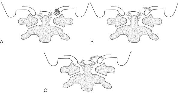 FIGURE 17-1, Anderson and Montesano classification of occipital condyle fractures. 1 A, Type I injuries are comminuted, stable impaction fractures caused by axial loading. B, Type II injuries are impaction or shear fractures extending into the base of the skull and are usually stable. C, Type III injuries are alar ligament avulsion fractures and represent unstable distraction injuries of the craniocervical junction.