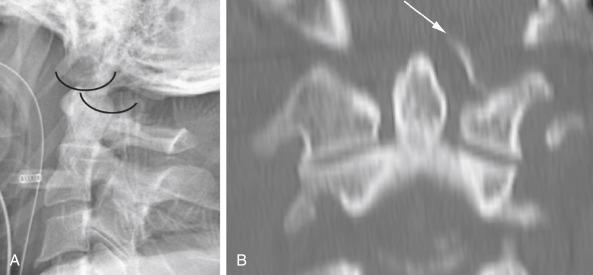 FIGURE 17-2, Type III occipital condyle fracture as a component of craniocervical dissociation. The lateral cervical spine radiograph ( A ) shows dislocation of the atlanto-occipital joints in a 48-year-old man involved in a high-speed motor vehicle collision. The coronal computed tomography image ( B ) illustrates an associated avulsion fracture of the left occipital condyle ( arrow ), resulting in functional incompetence of the attached alar ligament.