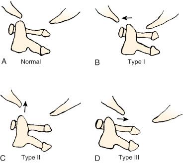 FIGURE 17-3, The Traynelis classification of craniocervical dislocation. A, Normal atlanto-occipital alignment. B, Type I: anterior displacement. C, Type II: distraction injury. D, Type III: posterior displacement.