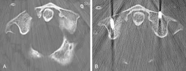 FIGURE 17-7, Direct repair of C1 lateral mass fracture. A, Axial computed tomography (CT) image of a right lateral mass fracture with an associated posterior arch fracture (not seen on this image) in a young male patient who had survived an airplane crash. B, Postoperative axial CT image shows direct repair of the C1 fracture with C1 lateral mass screws connected by a transverse bar. The indications for this procedure have not been well established, but the primary benefit appears to be in sagittal plane fractures of the lateral mass adjacent to the insertion of the transverse alar ligament in association with posterior arch fractures.