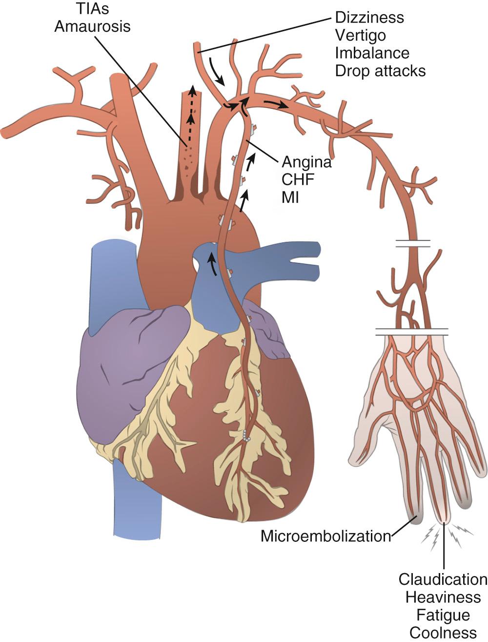 FIGURE 73-1, Common symptoms of occlusive disease involving the brachiocephalic branches. Compromised flow or emboli from common carotid artery lesions can cause a variety of neurologic symptoms, including transient ischemic attacks (TIAs) and amaurosis fugax. Subclavian artery lesions can cause vertebrobasilar insufficiency (including vertebral-subclavian steal), cardiac complications (including angina, myocardial infarction [MI], and congestive heart failure [CHF]) caused by coronary-subclavian steal, and upper-extremity arterial insufficiency or microembolization.