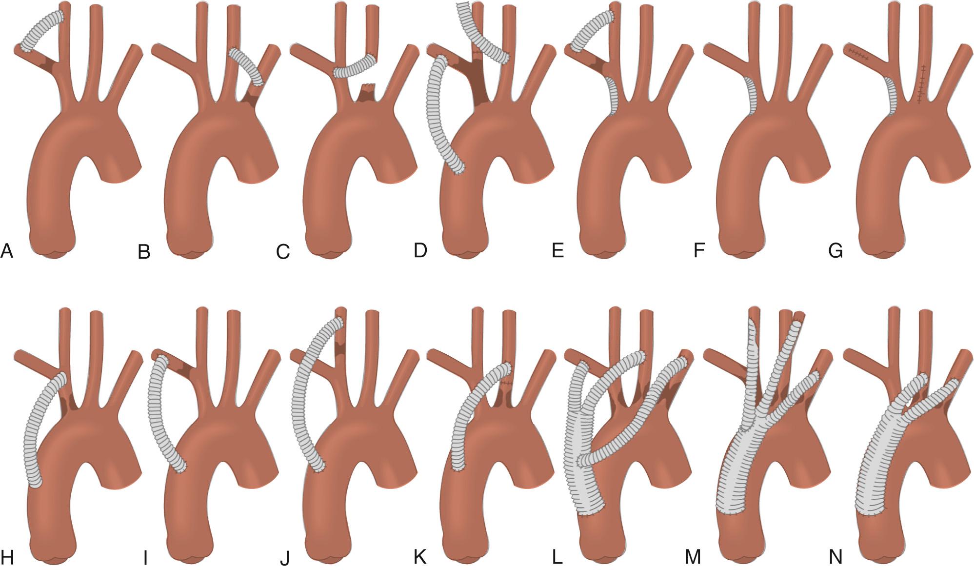 FIGURE 73-2, Options for open surgical reconstruction of the brachiocephalic branches include extra-anatomic bypass procedures (A-E), aorta-to-brachiocephalic artery bypass procedures (D, H-N), and endarterectomies (E-G) .