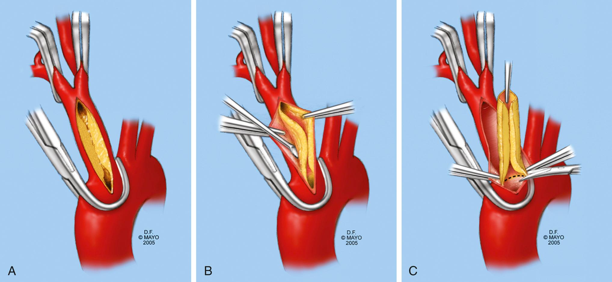 FIGURE 73-3, A, After the right common carotid and subclavian arteries are clamped, proximal control of the innominate artery is established with a partial occluding clamp placed on the aortic arch. A longitudinal arteriotomy is created to expose the lesion. B, A circumferential endarterectomy plane is developed in the middle of the media. C, The endarterectomy is tapered distally to an appropriate endpoint. The lesion is divided proximally (dashed line) near the origin of the innominate artery; if the plaque extends into the arch, the intima is secured with tacking sutures to prevent dissection. The arteriotomy can be closed primarily or with a patch.