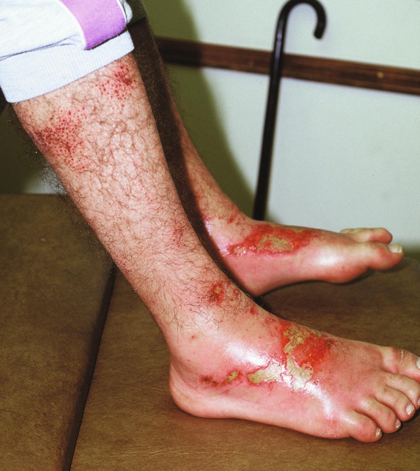 Fig. 66.1, Acute toxic insult–form of irritant contact dermatitis in a cement worker who developed cement burns from fresh cement getting into his boots.