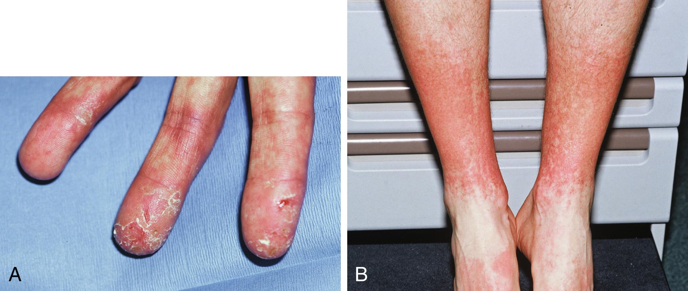 Fig. 66.2, Chronic allergic contact dermatitis. A, A case in an orthodontist who was allergic to nickel and to the glutaraldehyde used to sterilize his instruments. Note how the scaling dermatitis can mimic irritation. B, This patient developed sensitization to chromium, which was used to tan the leather in his work boots. The dorsal foot distribution is typical for a shoe contact dermatitis.