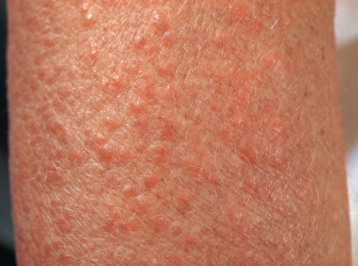 Fig. 16.7, Fiberglass dermatitis.