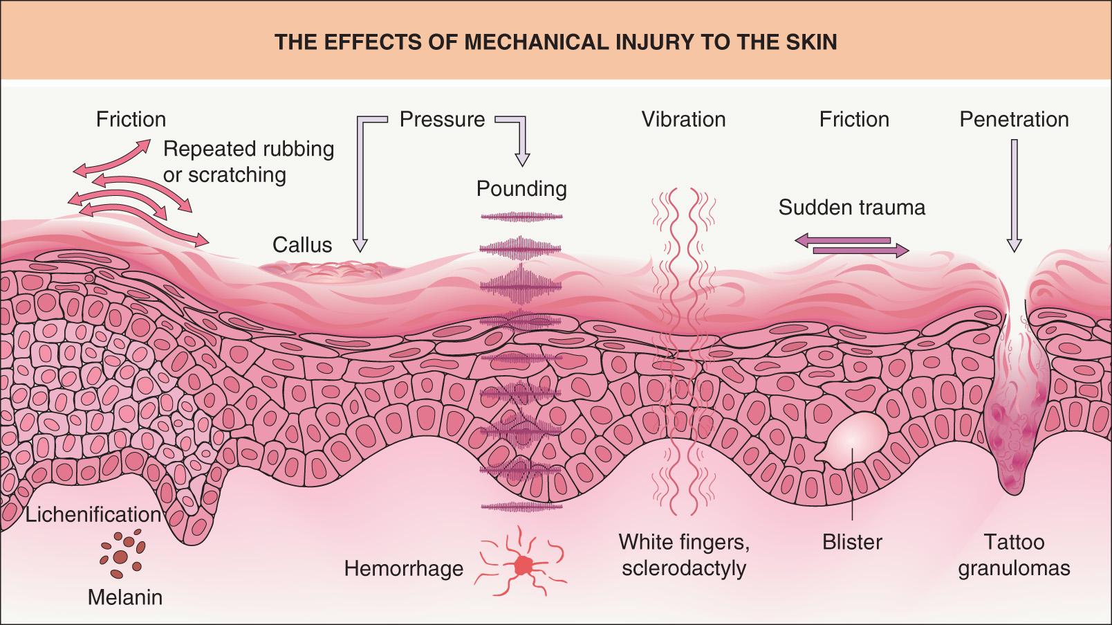 Fig. 16.8, The effects of mechanical injury to the skin.