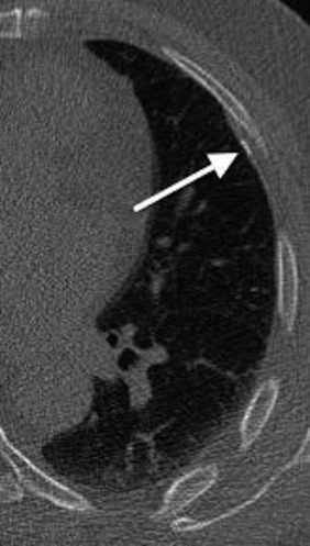 Figure 20.1, Partially calcified asbestos-related pleural plaques (arrow) were present bilaterally on lung cancer screening on a low-dose chest CT scan in a 72-year-old man with a 50 to 70 pack-year history of smoking and no known significant asbestos exposure.