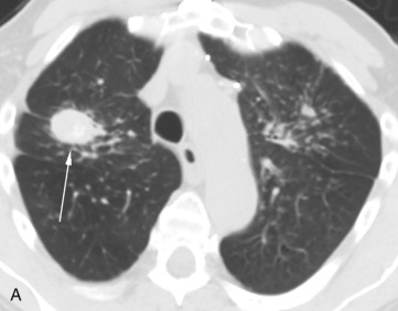 Figure 20.2, Progressive massive fibrosis in a 75-year-old man with a history of hard rock mining. (A) On CT, a unilateral right upper lobe conglomerate mass is present (arrow) , with subtle central calcification on a background of silicotic nodules. (B) Subsequent fused PET/CT image demonstrates associated increased FDG uptake (standard uptake value = 7.3) within the mass (arrow) , which remained stable for 3 years, consistent with progressive massive fibrosis. Although FDG uptake is a concerning feature, benign lesions can also be metabolically active.