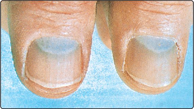 Fig. 74.1, Blue discolouration of the nails due to argyria in a silver smelter.