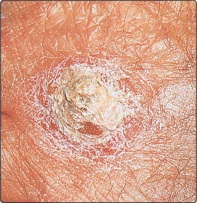 Fig. 74.3, A tar keratosis in a coking plant worker.