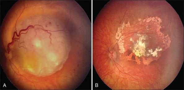 Figure 64.11, (A) Prechemoreduction and (B) postchemoreduction appearance of a large solitary retinoblastoma nodule.