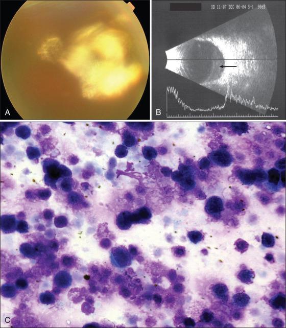 Figure 64.12, Intraocular lymphoma. (A) Fundus appearance of hazy vitreous with the yellowish plaquelike lesions of intraocular lymphoma. (B) Combined A- and B-scan showing the tumor infiltrate in vitreous (arrow). (C) Atypical lymphocytes within the cellular debris retrieved with vitreous tap.