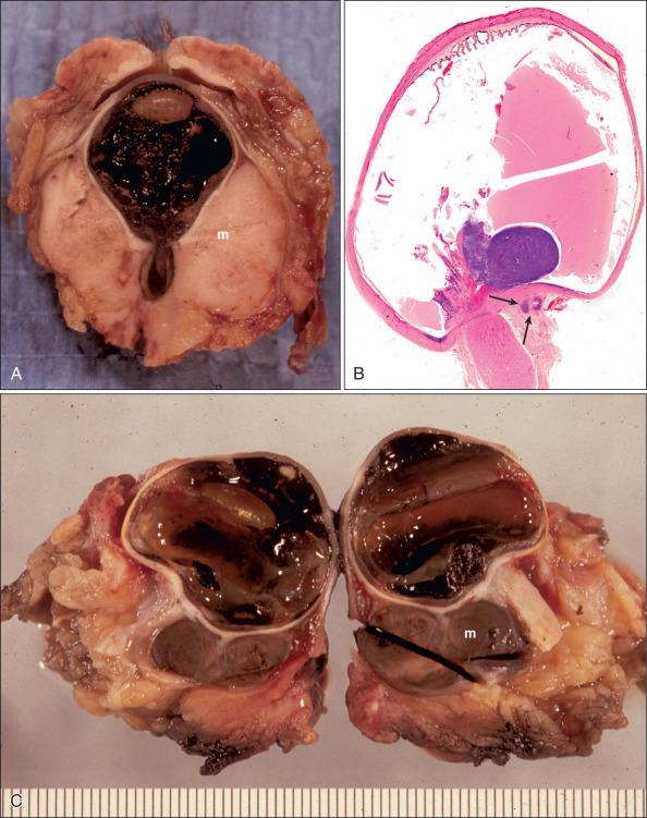 Figure 64.2, Orbital extension of choroidal melanoma. (A) The tumor (m) extends into the optic nerve and the orbital soft tissues. Note that it is amelanotic in the orbit but densely pigmented in the optic nerve. (B) The low-power histopathologic appearance of a juxtapapillary melanoma extending into orbital soft tissues (arrows). (C) The orbital component of this melanoma (m) is as densely pigmented as the intraocular primary tumor.