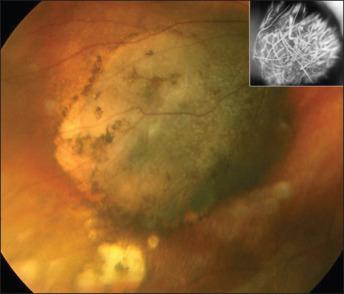 Figure 64.4, Funduscopic appearance of pigmented choroidal melanoma as a dome-shaped elevation; orange pigment partly covers its surface. Inset: Intravenous fluorescein angiography of the tumor depicts diffuse vascularity.