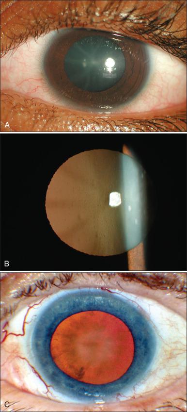 Figure 64.6, (A–C) Slit lamp appearance of cataracts resulting from radiation.
