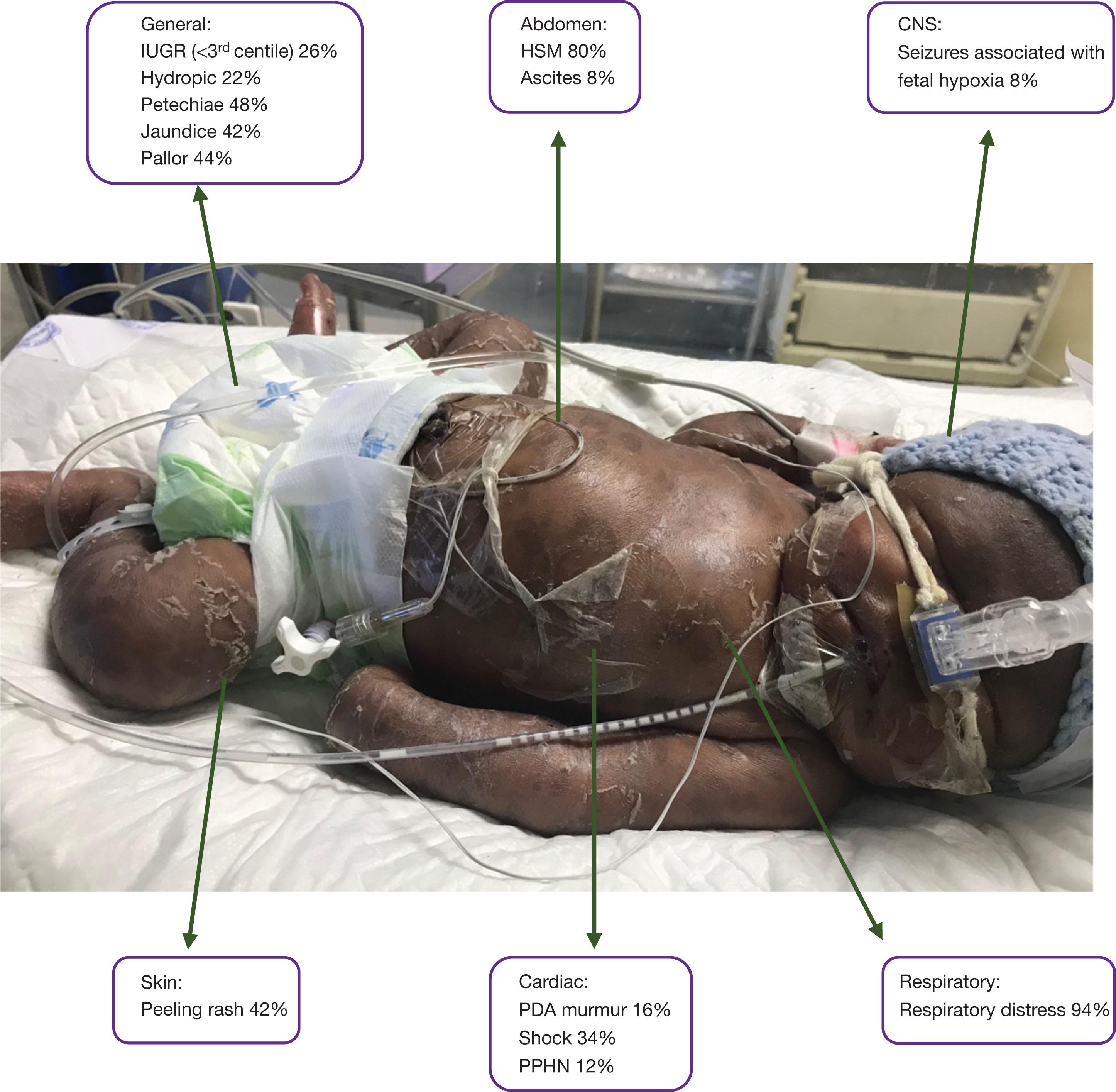 Fig. 11.4, Clinical signs in 50 South African neonates with symptomatic congenital syphilis. 23 CNS, central nervous system; HSM, hepatosplenomegaly; IUGR, intrauterine growth restriction; PDA, patent ductus arteriosus; PPHN, persistent pulmonary hypertension of the newborn.