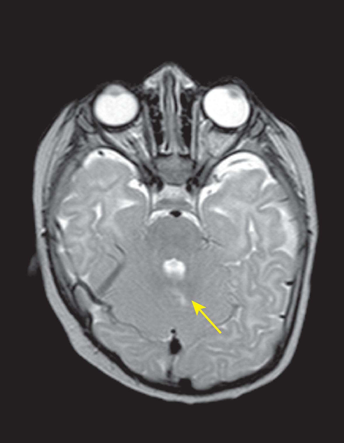 Fig. 85.1, Congenital left third nerve palsy. Axial T2-weighted scan shows superior vermis lesion (yellow arrow). (Other presumed perinatal hypoxic ischemic lesions seen elsewhere.)